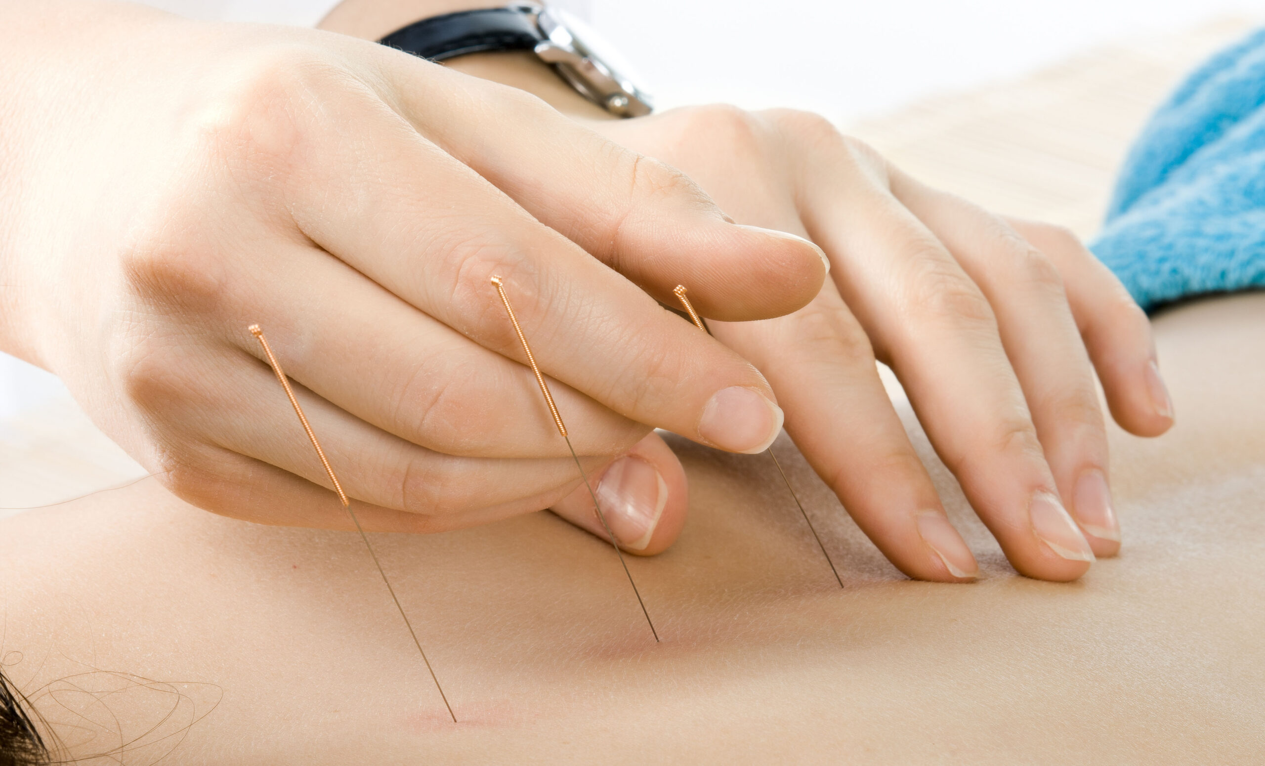 dry needling melbourne